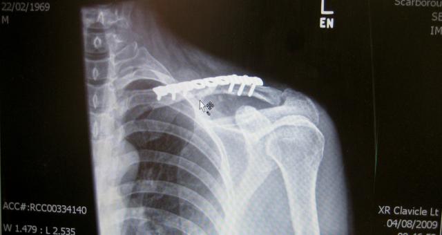 Clavicle injuries are common among cyclists